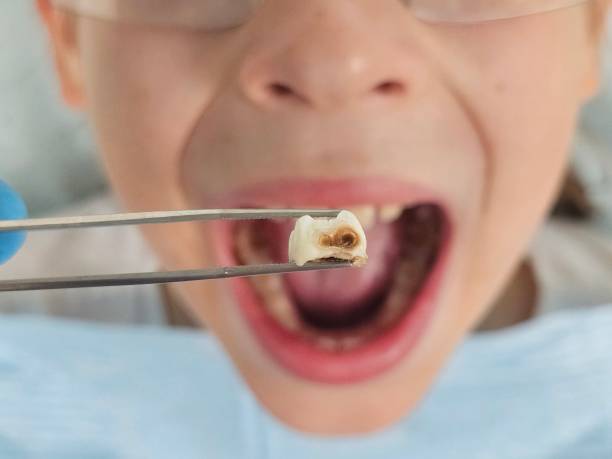 Best Emergency Dental Care for Broken or Chipped Teeth in Columbus Af, MS